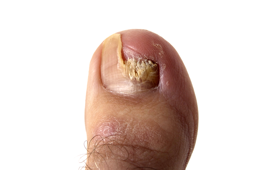 bigstockphoto toenail fungus 6049466 Foot Fungus Home Cures